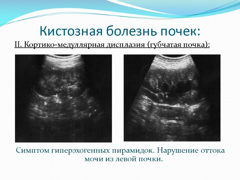 Кистозная болезнь почек: II. Кортико-медуллярная дисплазия (губчатая почка):      